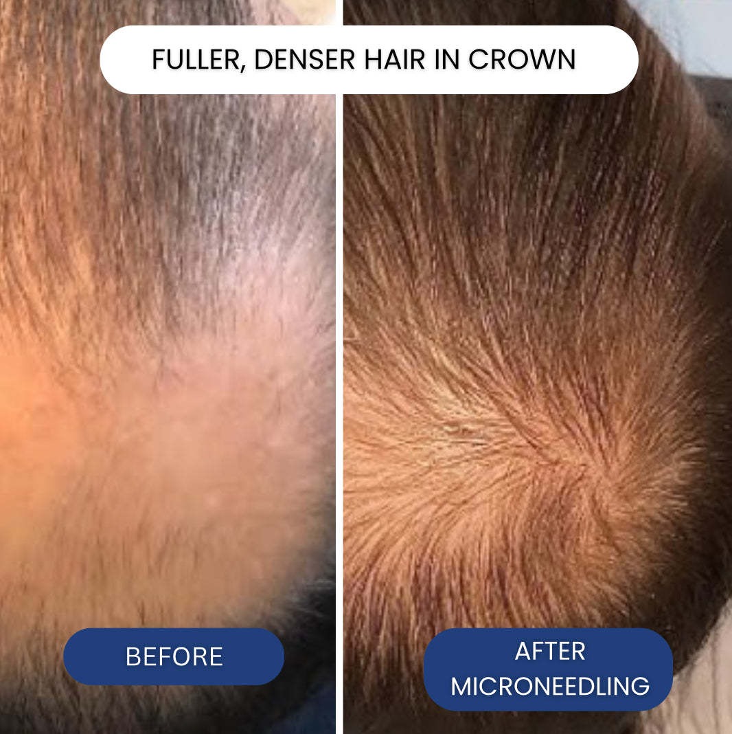 Hair Regrowth Microneedling GH - огляд і ціна Ingrown Hair Serum